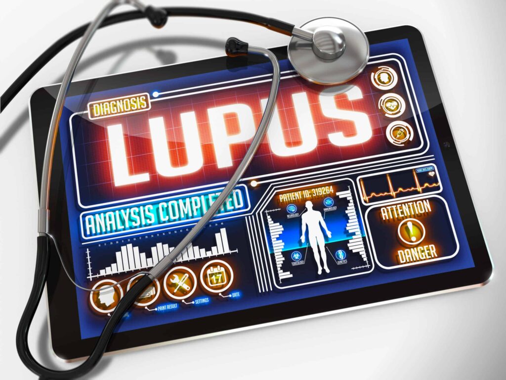 Environmental Exposures & Lupus